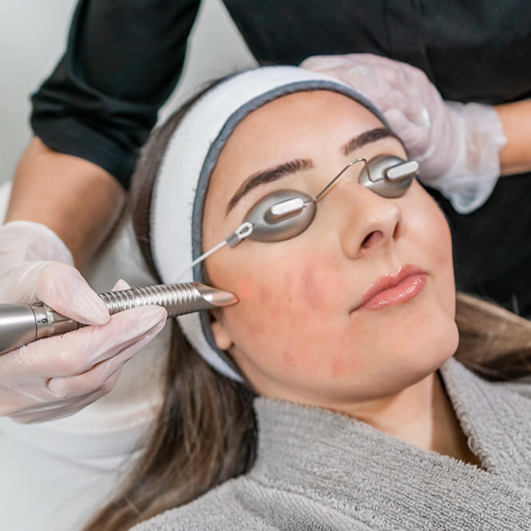 Full Face Acne Treatment / Scar Revision