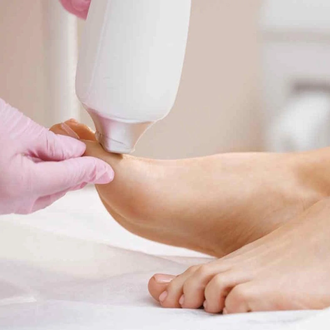 Feet Laser Hair Removal