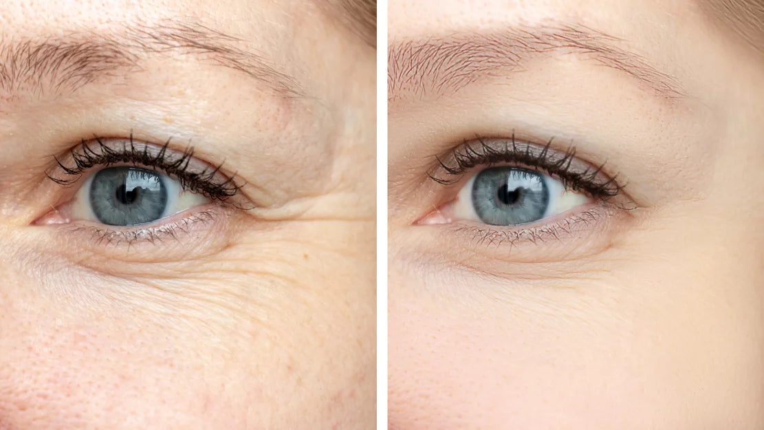 Smooth Lase/Eye Lase