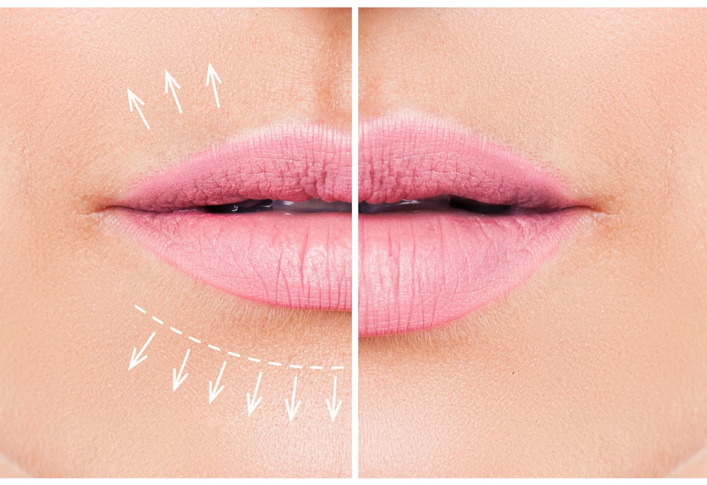 Lip Lase/Lip Plump