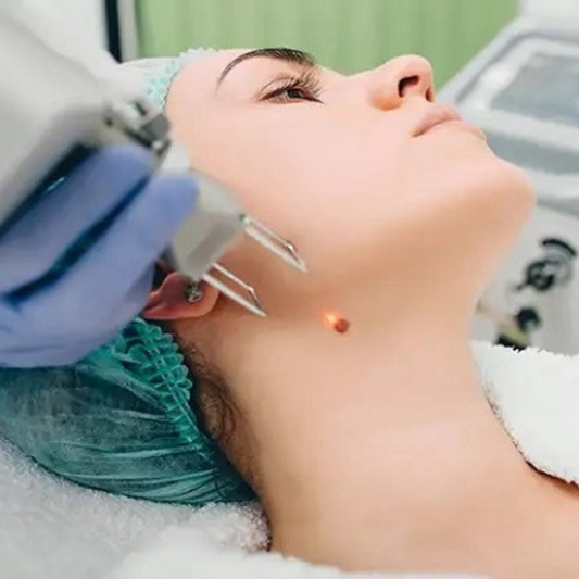 Wart Removal
