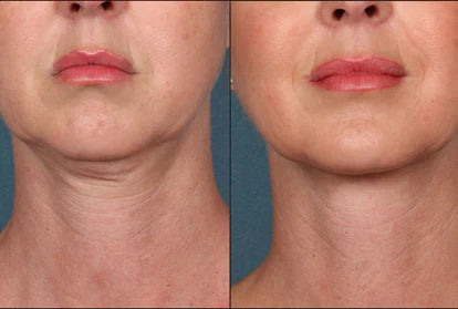 Fotona 4D Facelift (Face/Neck)