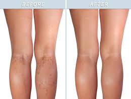 Spider Veins